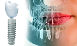 تاریخچه ایمپلنت دندانی