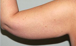 عواقب لیفت بازو یا براکیوپلاستی
