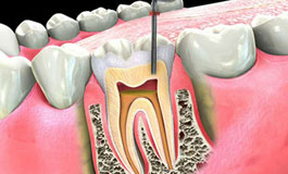 درد بعد از عصب کشی در دندان