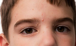 مشکلات پوستی کودکان با باکتری