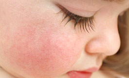 مشکلات پوستی در کودکان