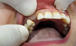 ایمپلنت دندان به زبان ساده