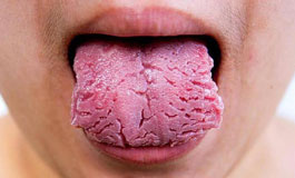 علائم ترک خوردن زبان