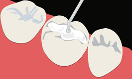 دلایل و نحوه عصب کشی دندان ها
