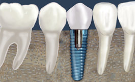 کاندید عمل ایمپلنت دندان