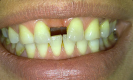 عوامل از دست دادن دندان ها