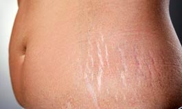 درمان افتادگی و ترک پوست با لیزر