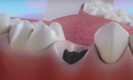 عصب کشی دندان خراب شده