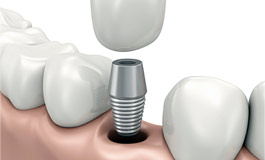 مروری بر ایمپلنت دندان