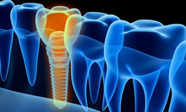 ایمپلنت جایگزین ریشه دندان