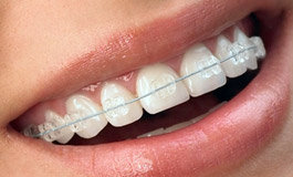 براکت شفاف دندان