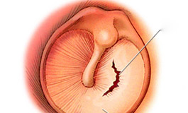 پارگي‌ پرده‌ گوش‌