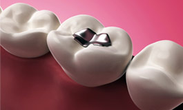 عملکرد ایمپلنت دندانی
