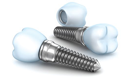 ایمپلنت‌‌های دندانی
