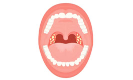 حقایقی درباره عفونت گلو