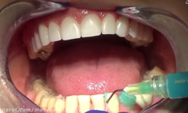 فرآیند زیباسازی دندان ها