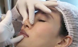 عمل زیبایی بینی با تزریق فیلر