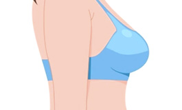 پروتز سینه