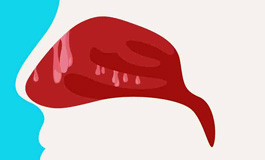 انواع تومور بینی و سینوس های آن