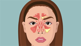 علل ابتلا به سینوزیت پیشانی