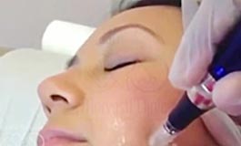 جوانسازی صورت با میکرودرم ابریژن