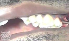کشیدن دندان پوسیده