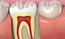 چگونگی انجام عصب کشی دندان