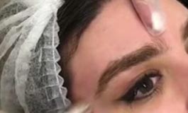 میکرودرم ابریژن و جوانسازی