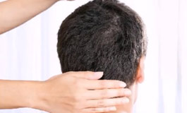 پی آر پی و رویش مجدد مو