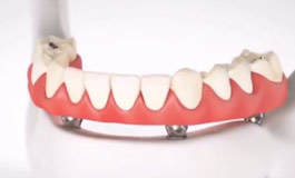 دندانپزشکان و ایمپلنت دندان