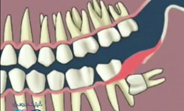 دندان عقل و عفونت لثه