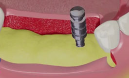 جراحی کاشت ایمپلنت دندان