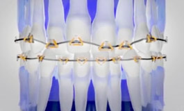 ارتودنسی سریع دندان ها