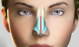 اصلاح نوک بینی در رینوپلاستی