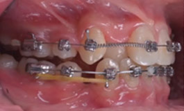ارتودنسی و فضای بین دندان ها